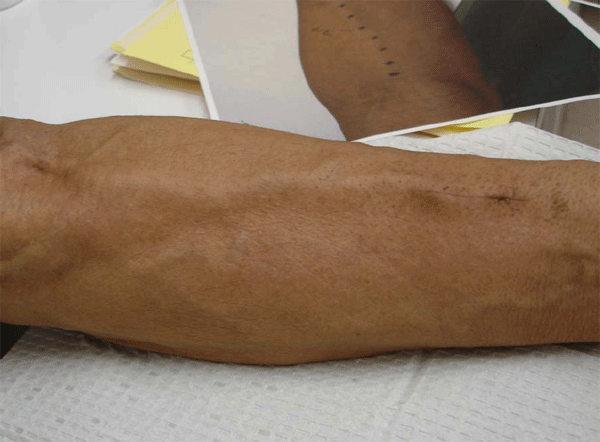 Gallery Of Medical Photos Michigan Vascular Access